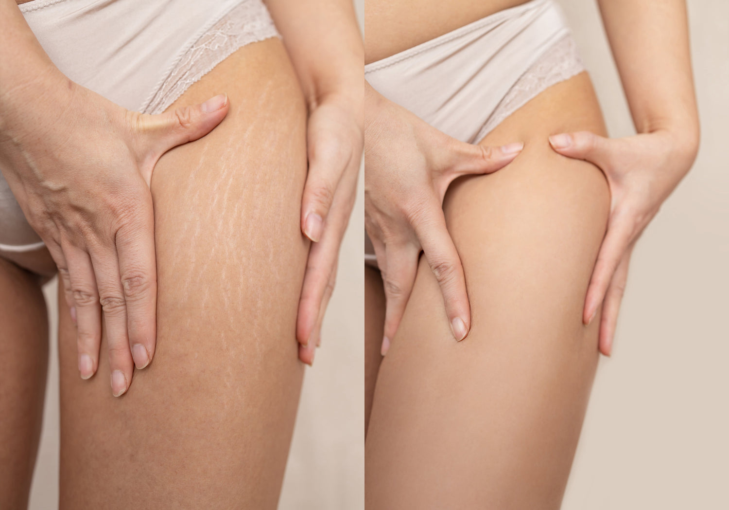 Visible reduction of cellulite and stretch marks after RF & Microneedling body treatment – before shows uneven skin texture, after shows smoother, firmer skin