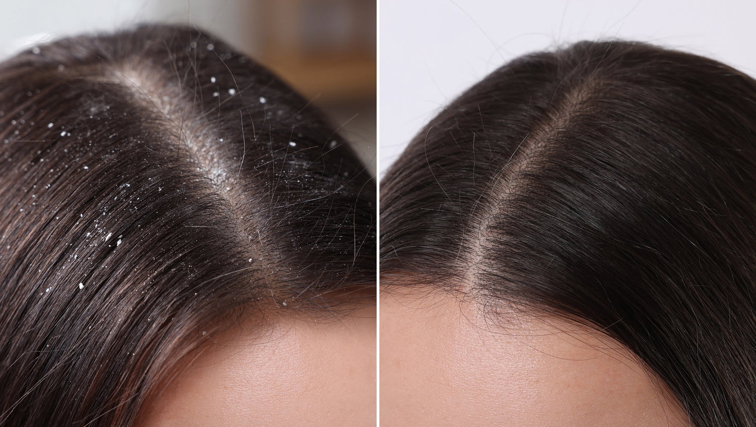 Side-by-side image showing results of the HydraFacial Keravive scalp treatment: on the left, a dry, flaky scalp with thin hair; on the right, a hydrated, nourished scalp with visibly fuller, healthier hair strands