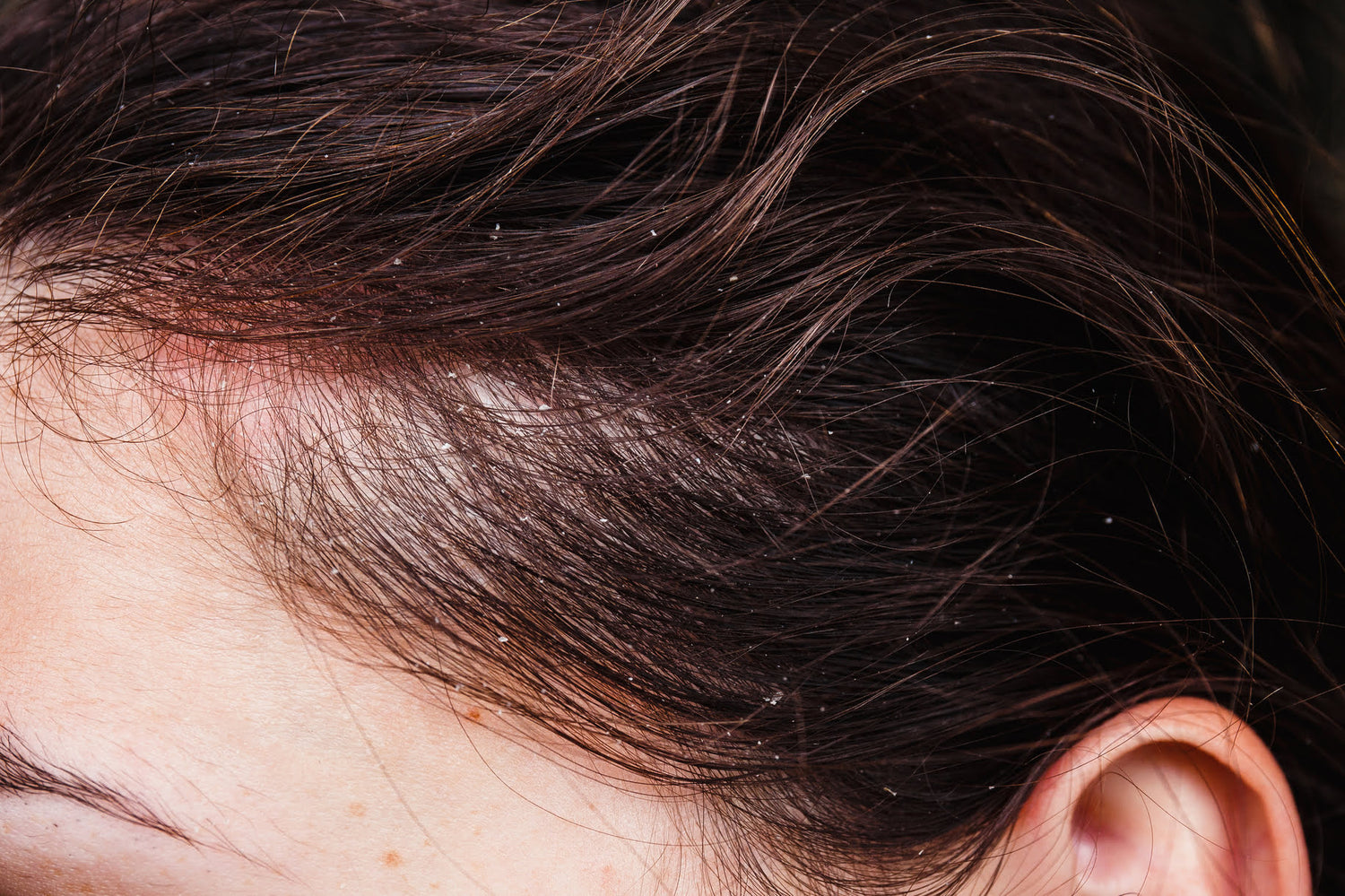 Close-up of a dry, flaky scalp with visibly thin and fragile hair strands, highlighting common signs of scalp dehydration and weakened hair growth