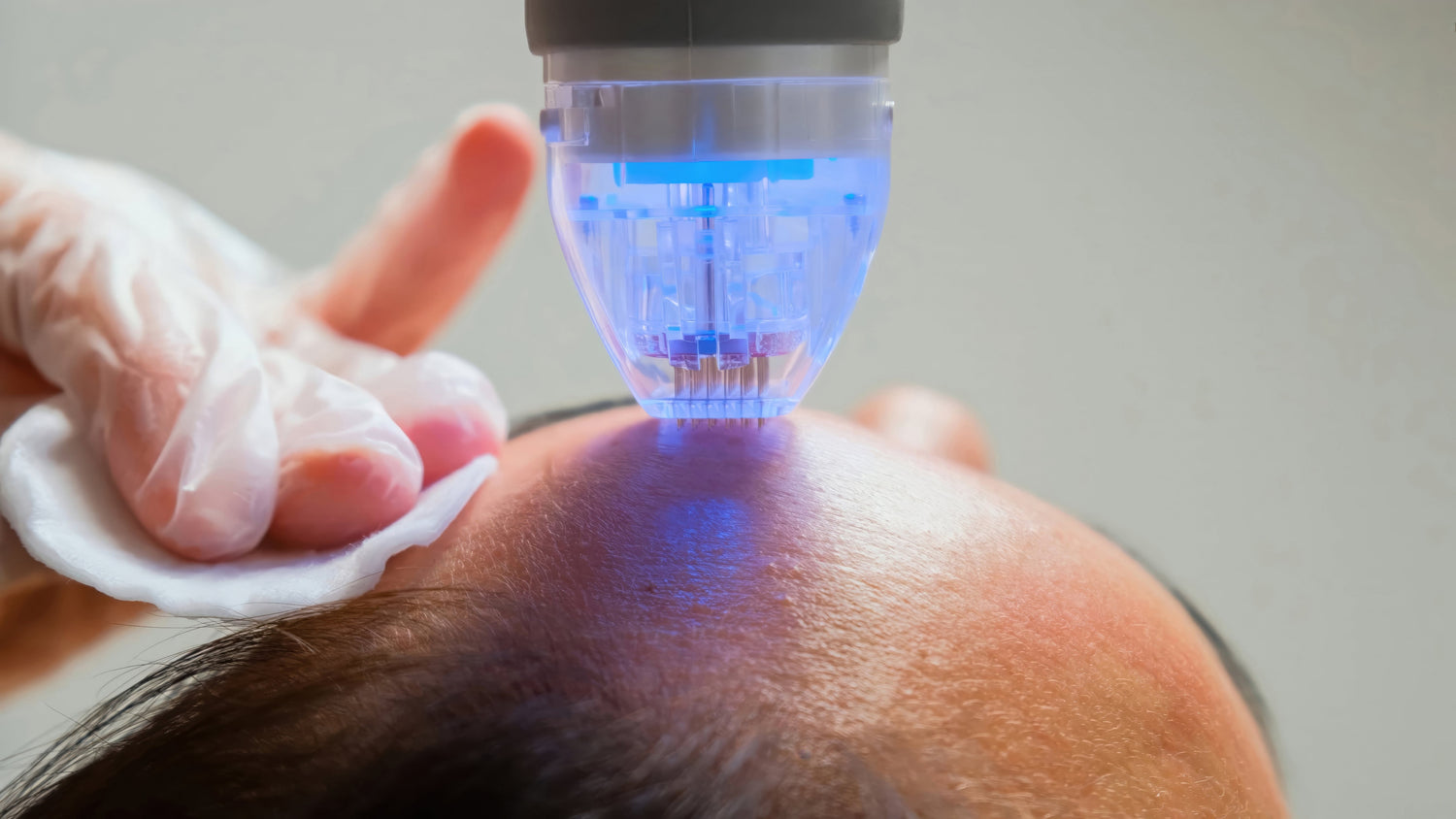A close-up of RF microneedling facial treatment being performed, showing a glowing blue-tipped device delivering radiofrequency energy and microneedles to the skin for collagen stimulation, skin tightening, and texture improvement