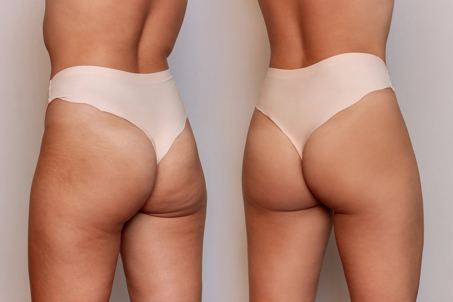 Side-by-side comparison of thighs and buttocks before and after Anti-Cellulite Body Treatments — left side shows visible cellulite and uneven skin, right side shows smooth, firm, and toned skin