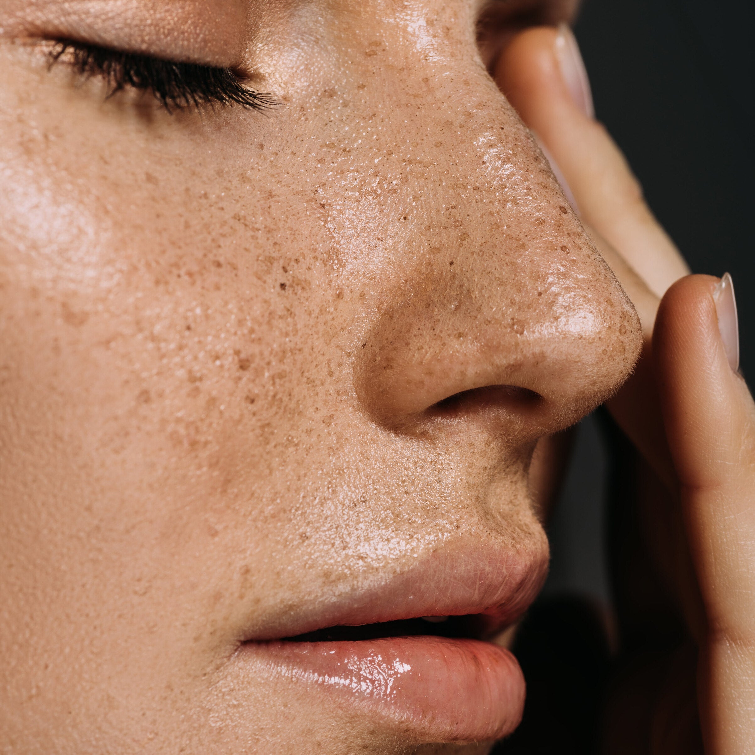 Laser Pigmentation Removal
