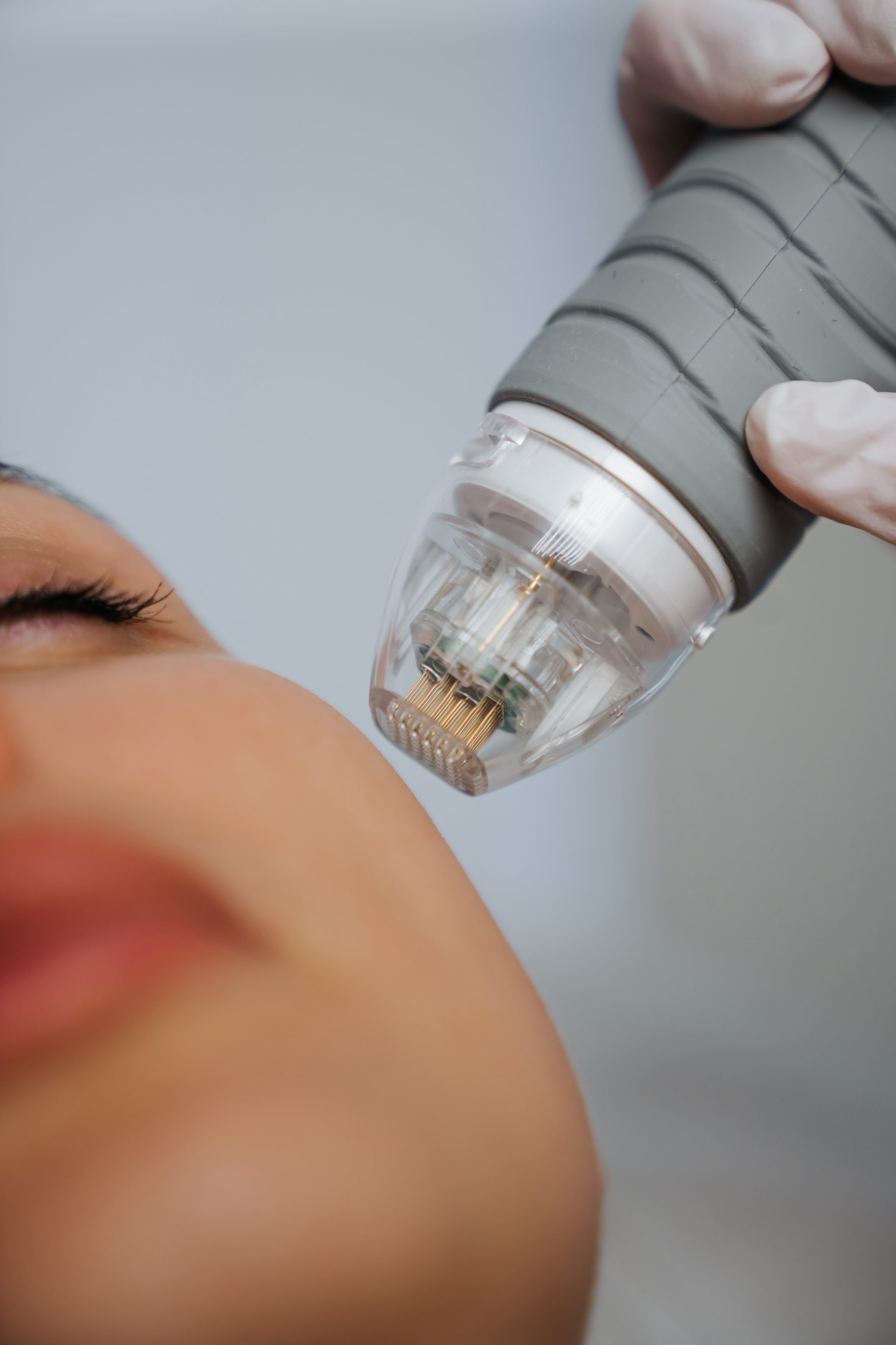 Microneedling
