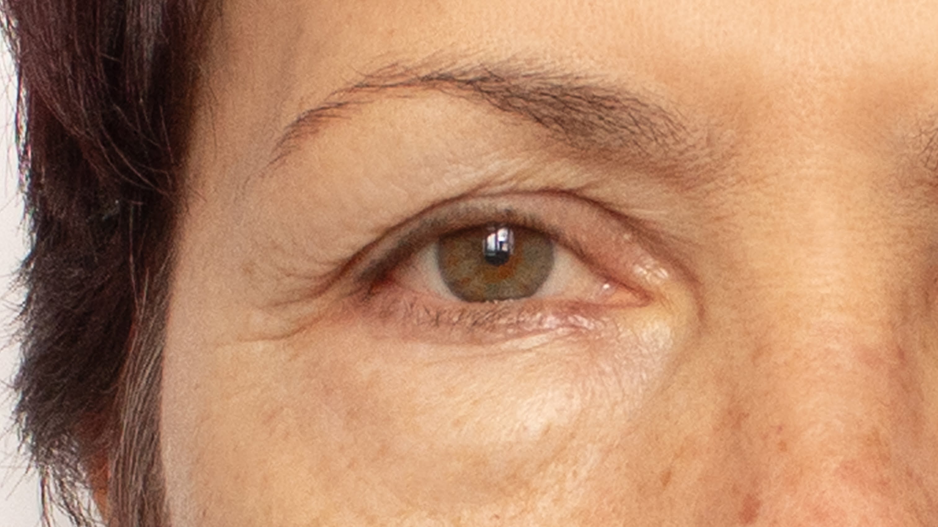 crow's feet before treatment