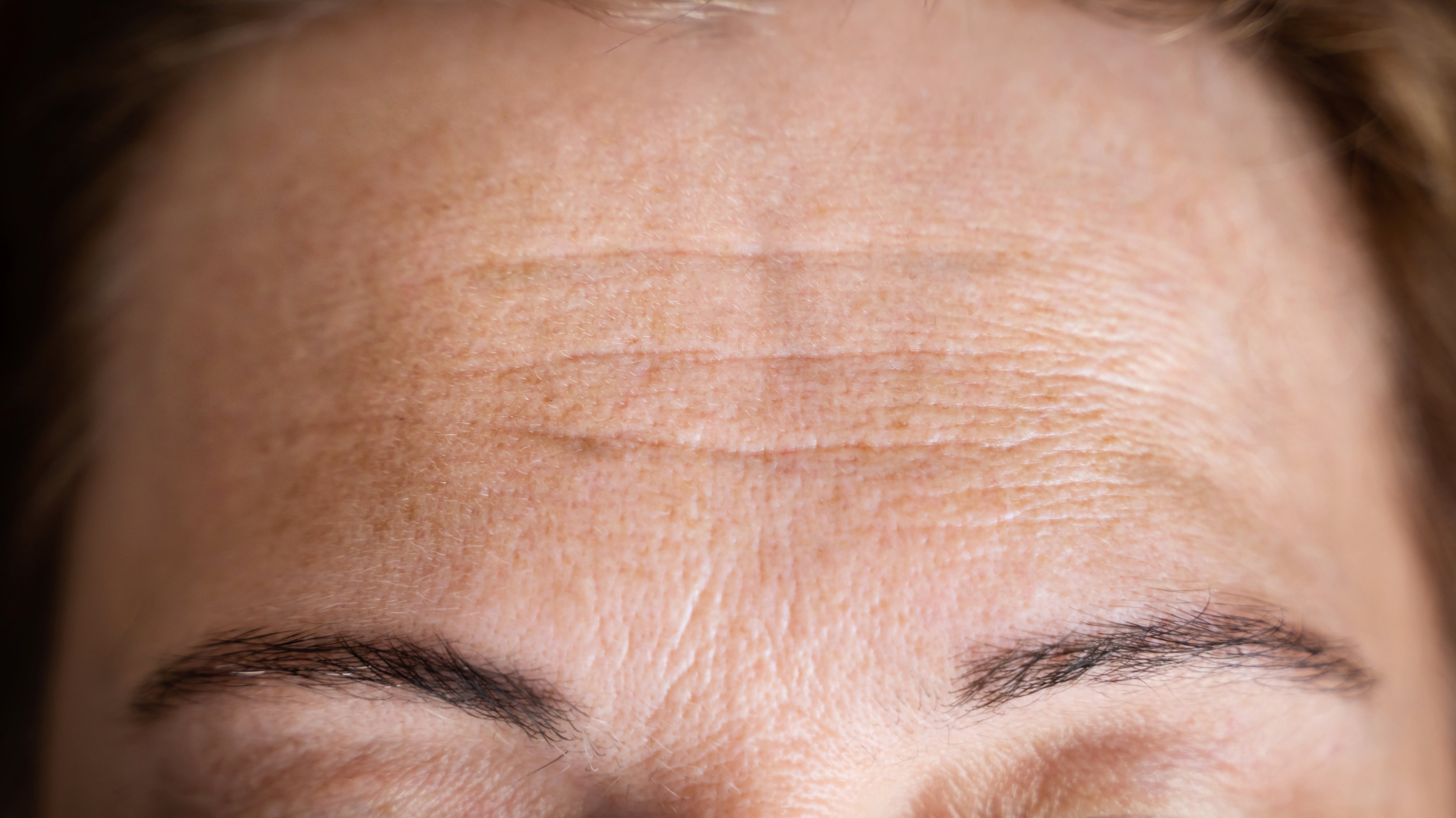 forehead lines before treatment