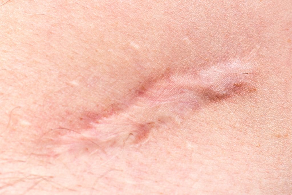 hypertrophic scar
