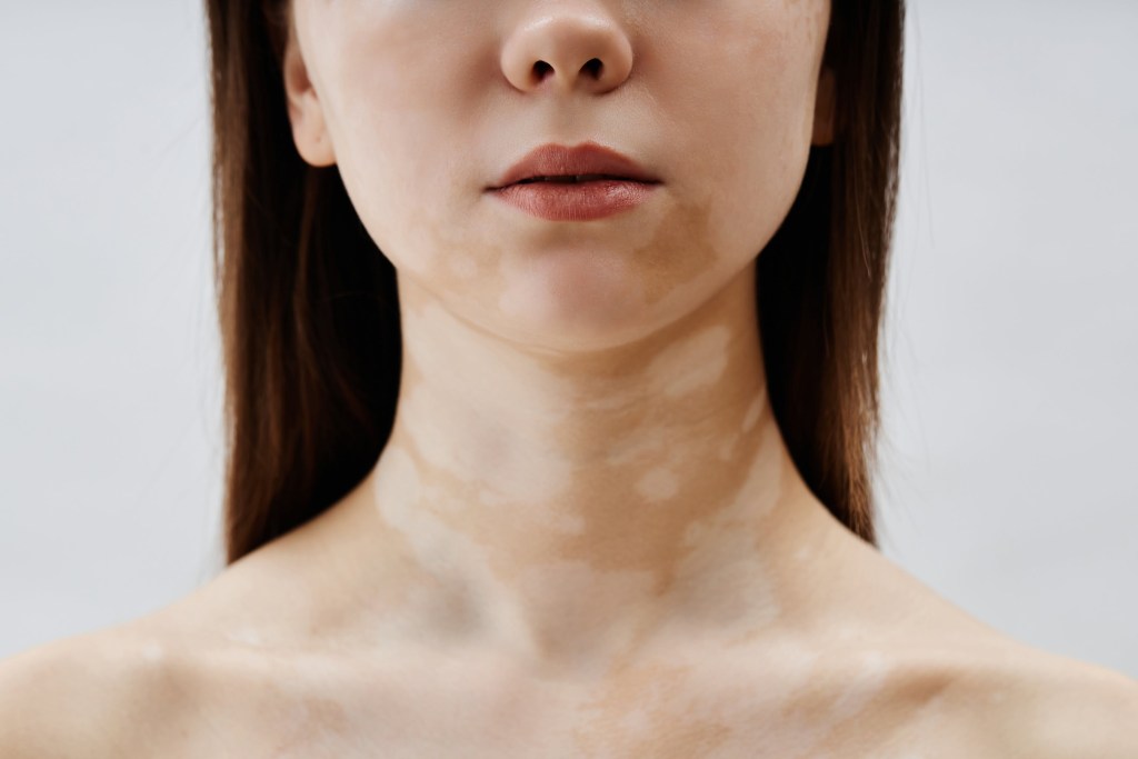 pigmentation patches