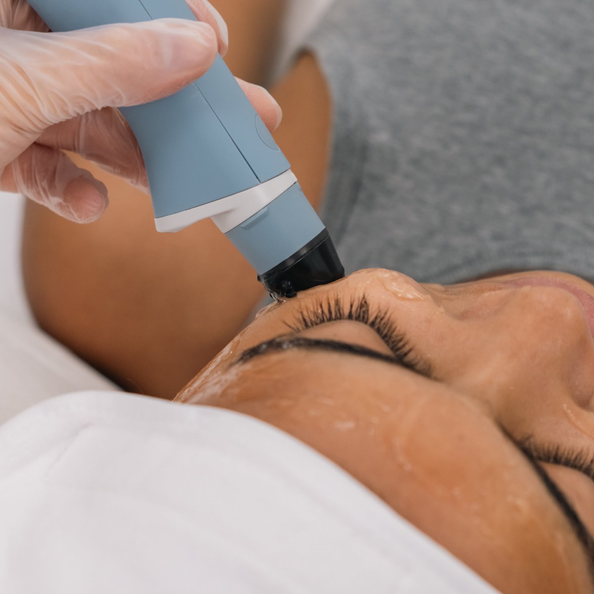 rf facial with targeted ultrasound