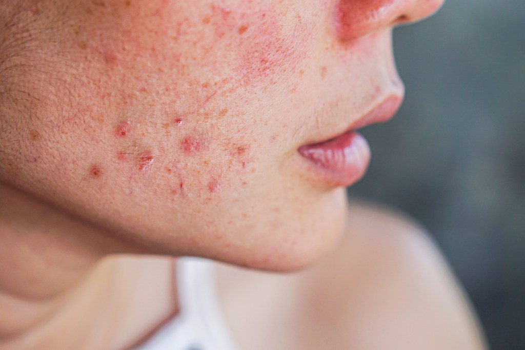 acne skin