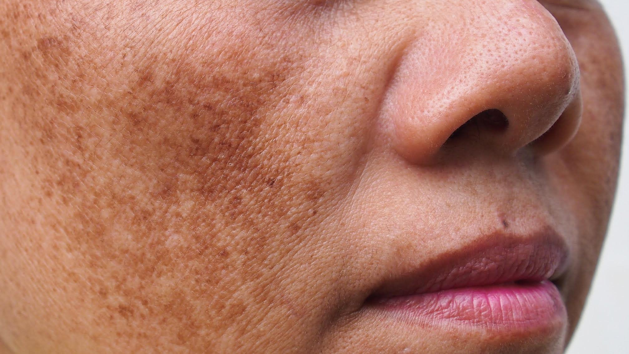 pigmentation before treatment