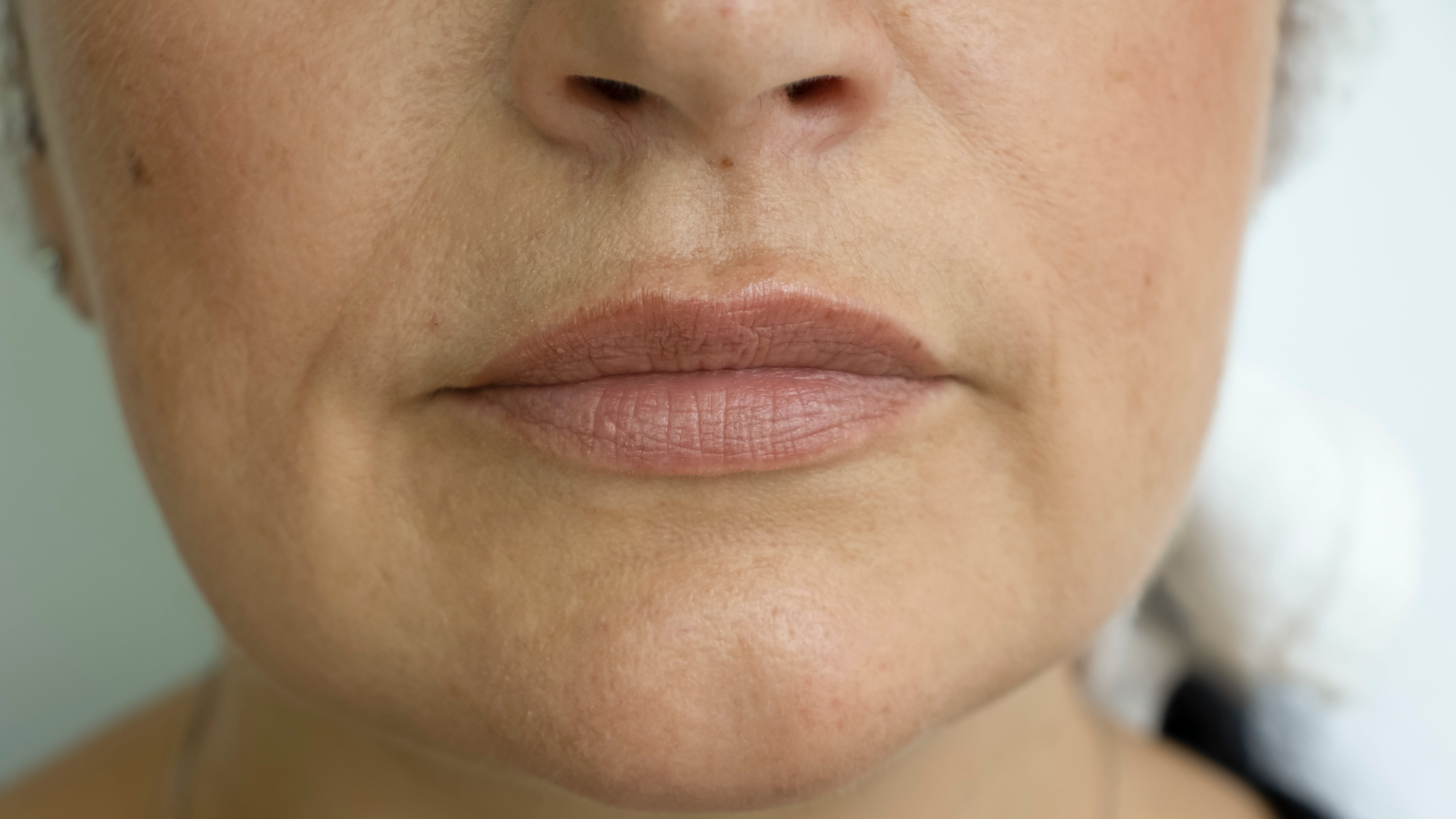 neck mouth nose lines before treatment neck mouth nose lines before treatment