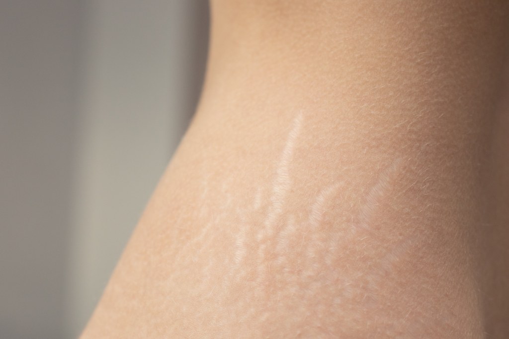 stretch marks 2
