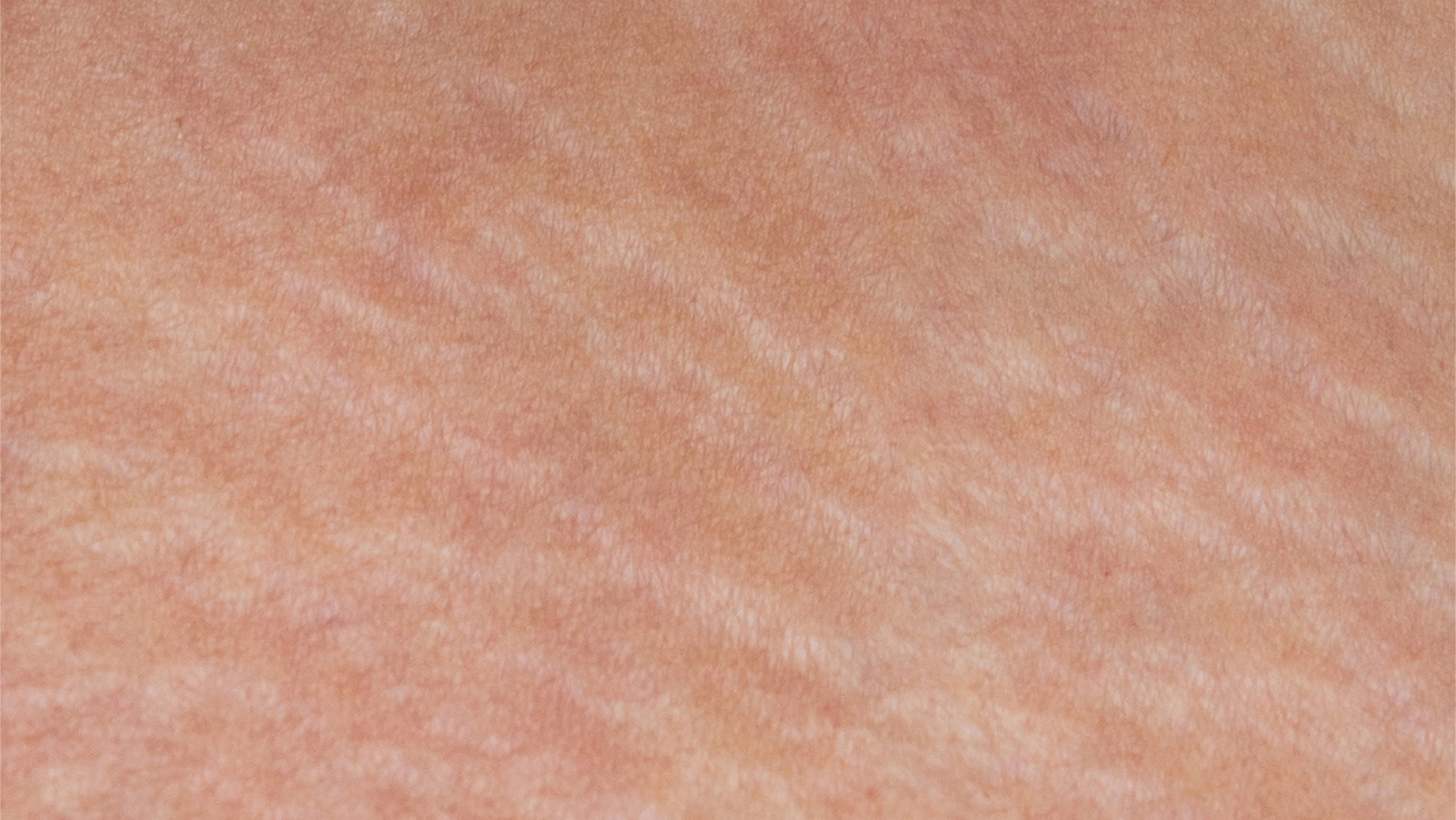 stretch marks before treatment