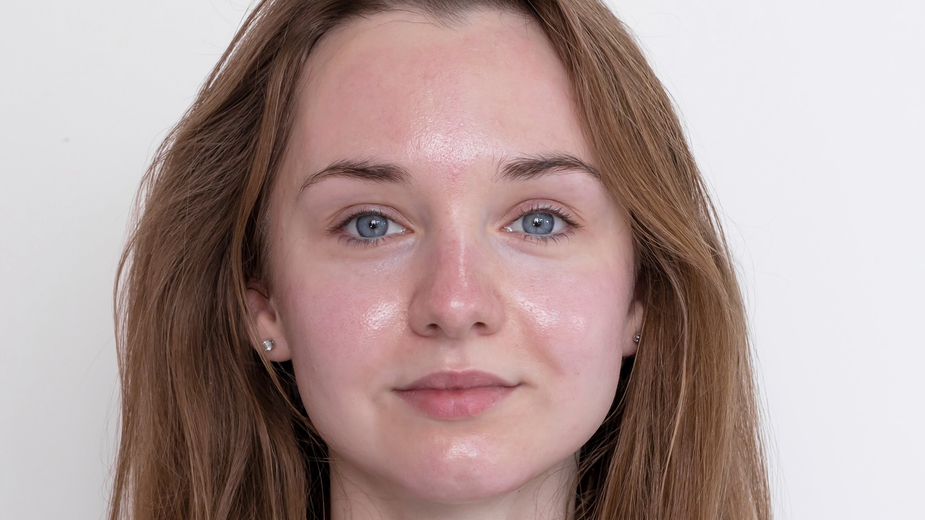 after rf microneedling facial