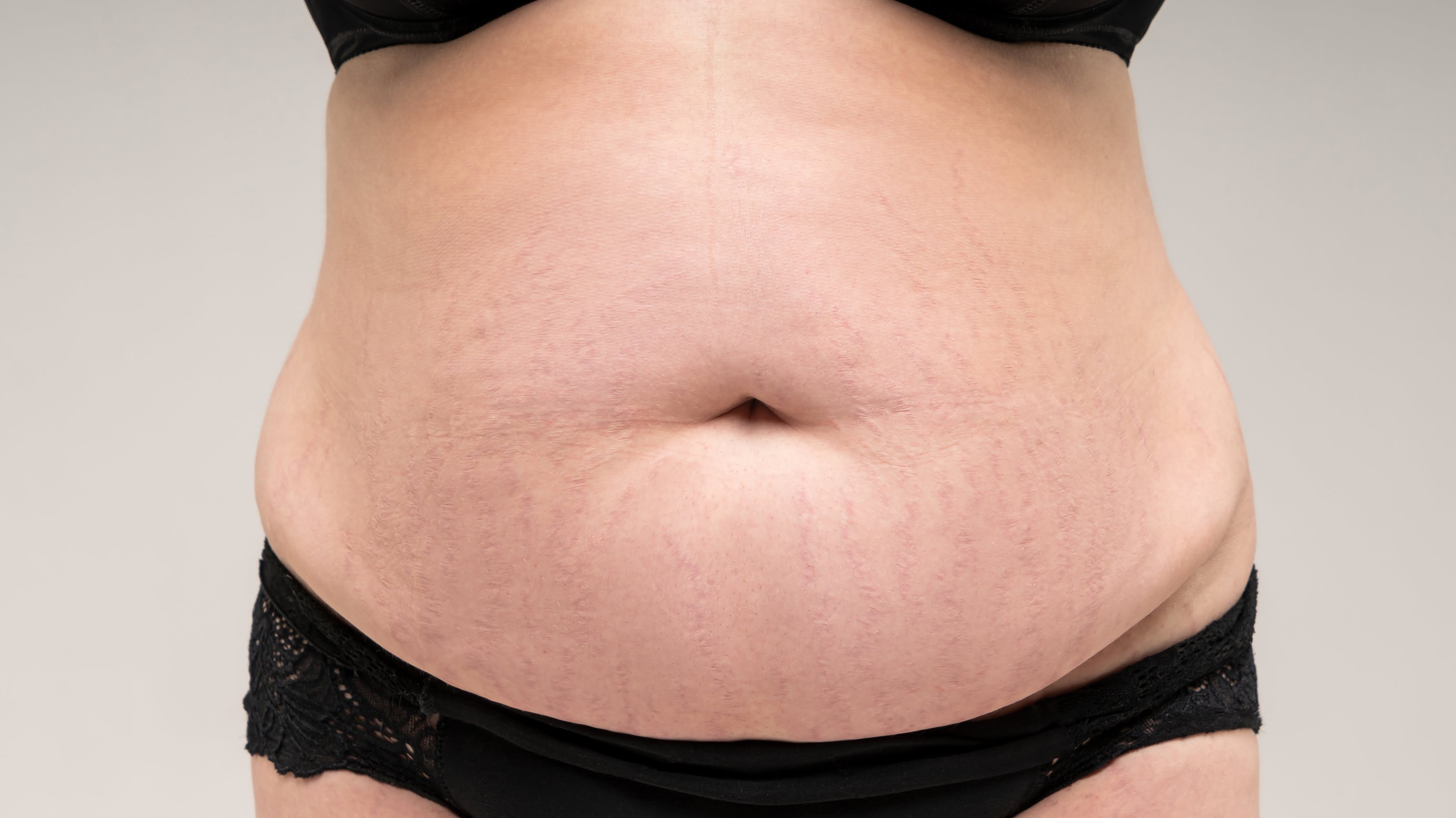 after rf & targeted ultrasound – body