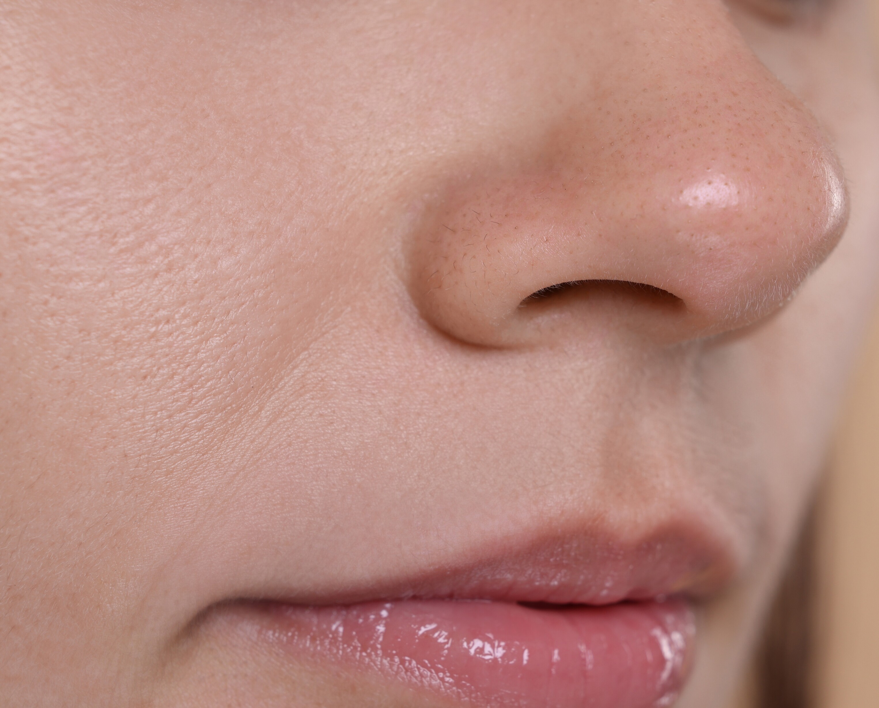 after chemical peels