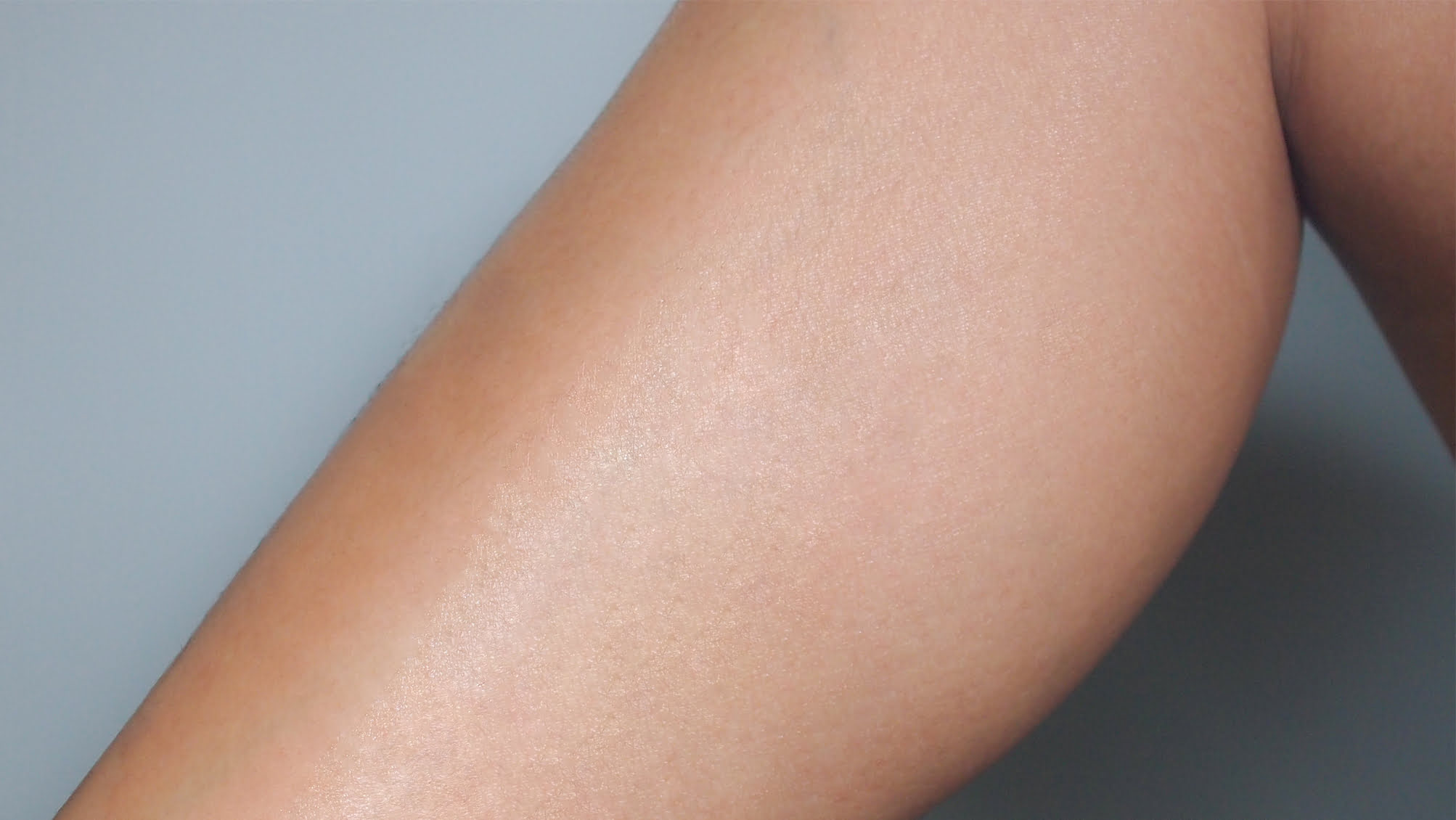 after laser hair removal