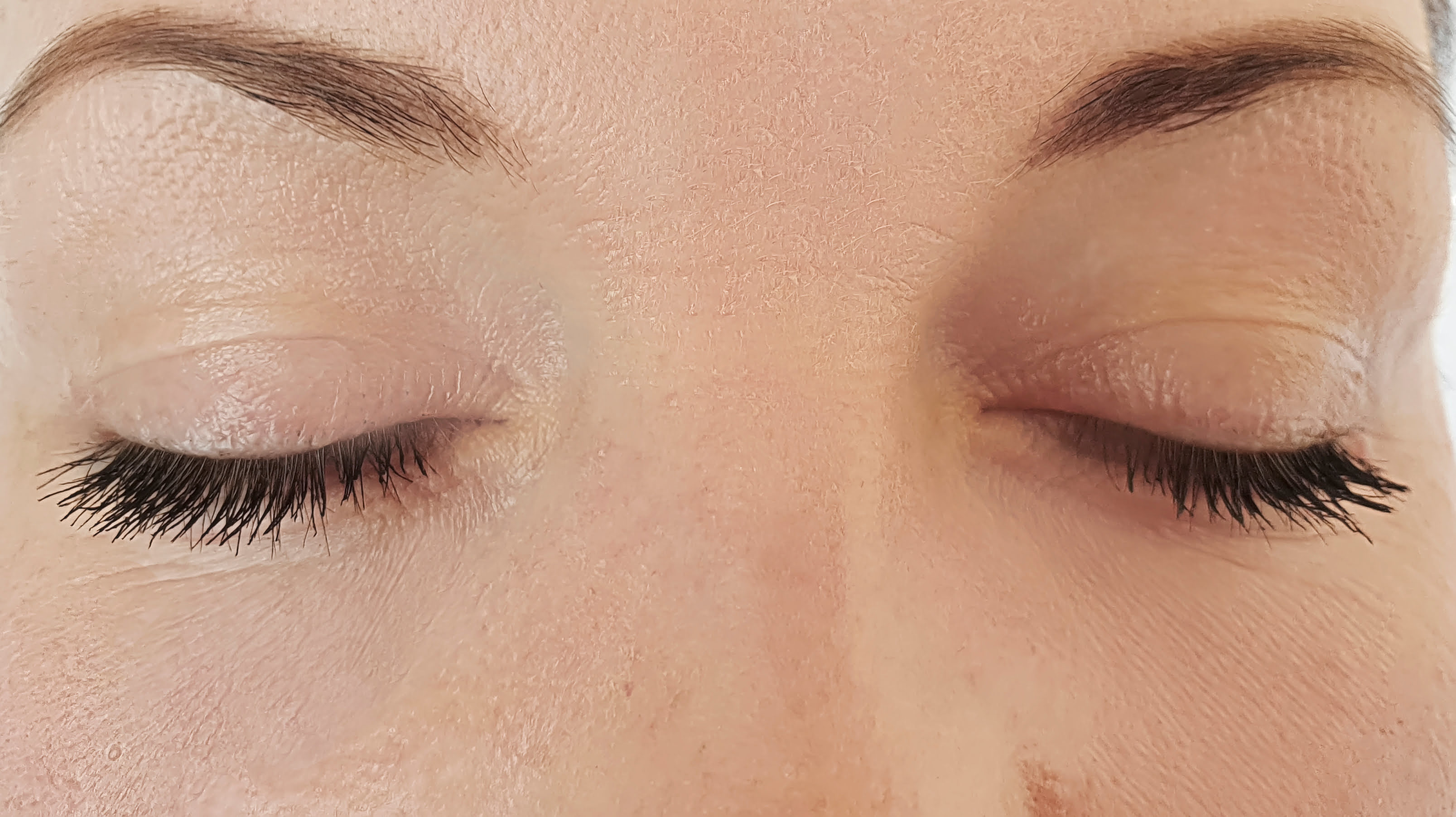 after profhilo treatment