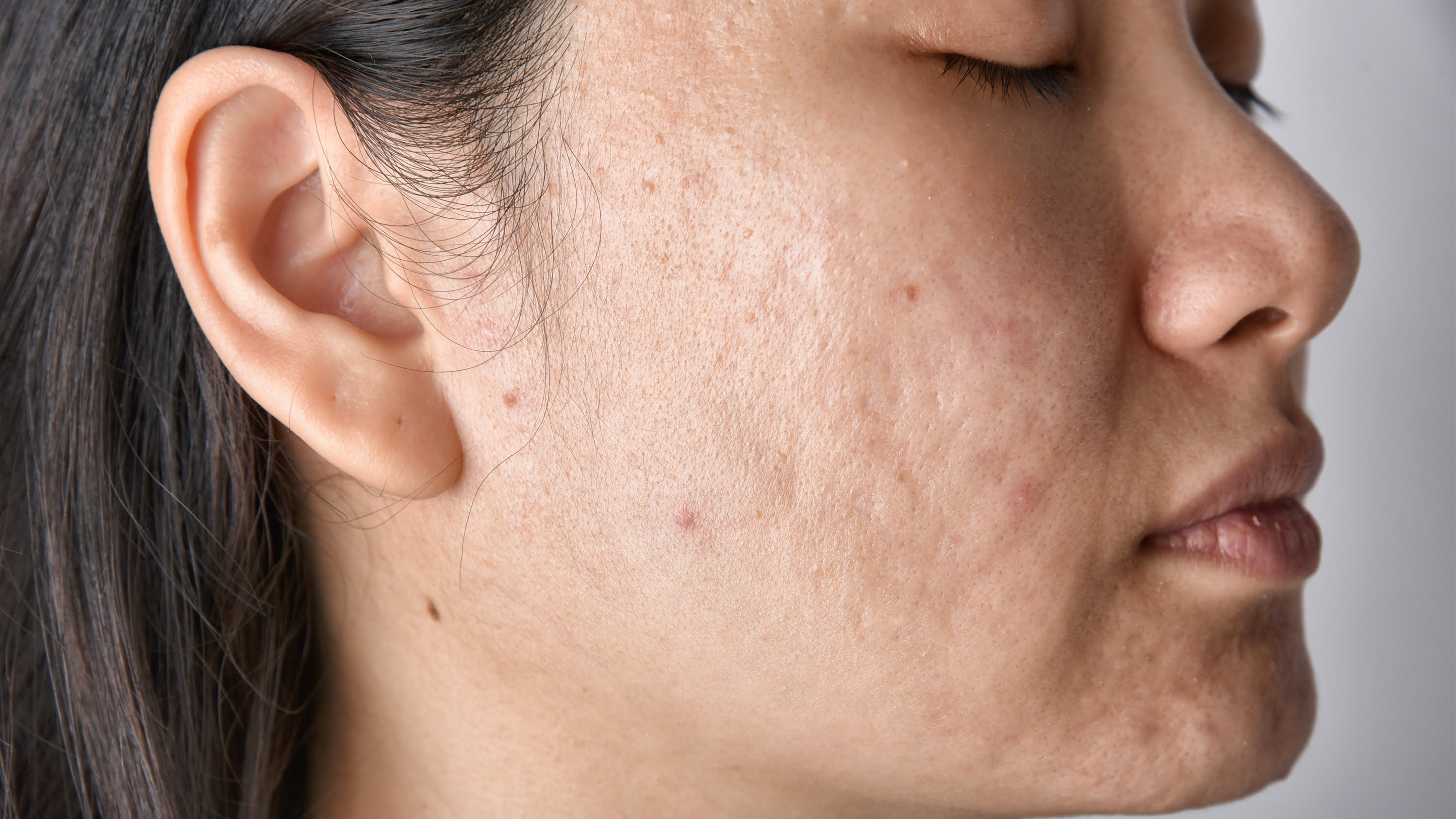 before led light therapy facial before led light therapy facial