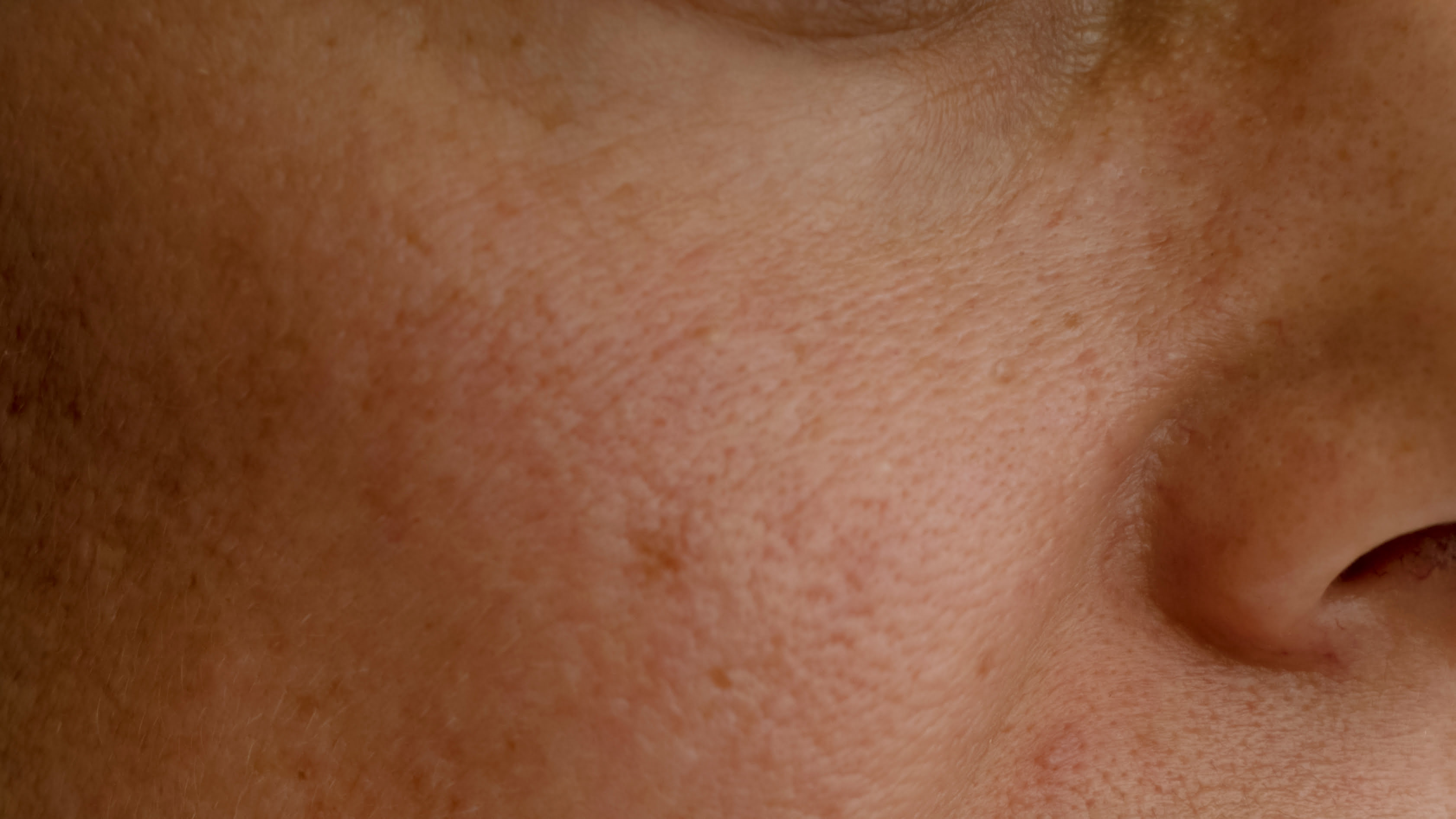 before lpg endermologie