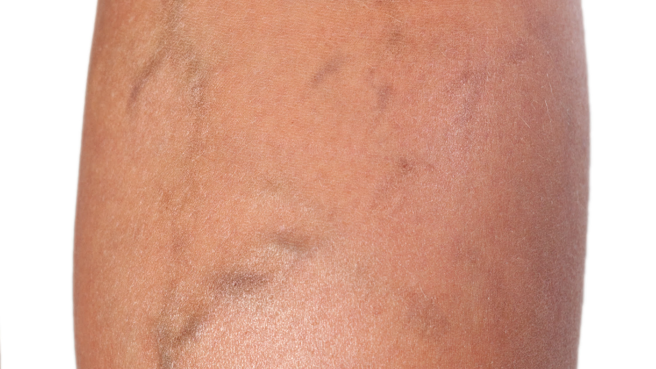 before laser thread vein removal