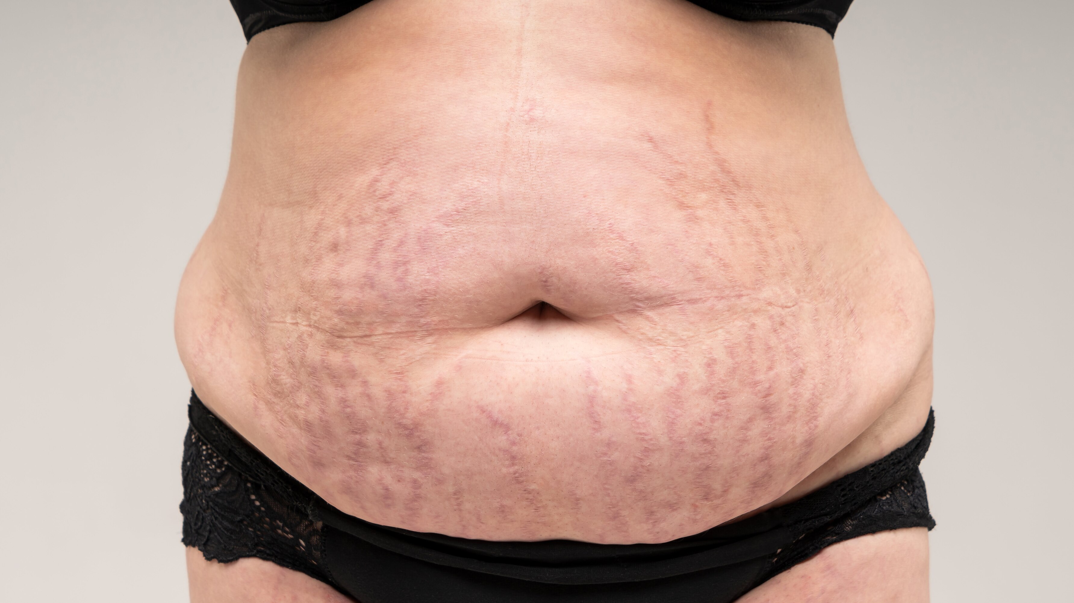 before rf & targeted ultrasound – body