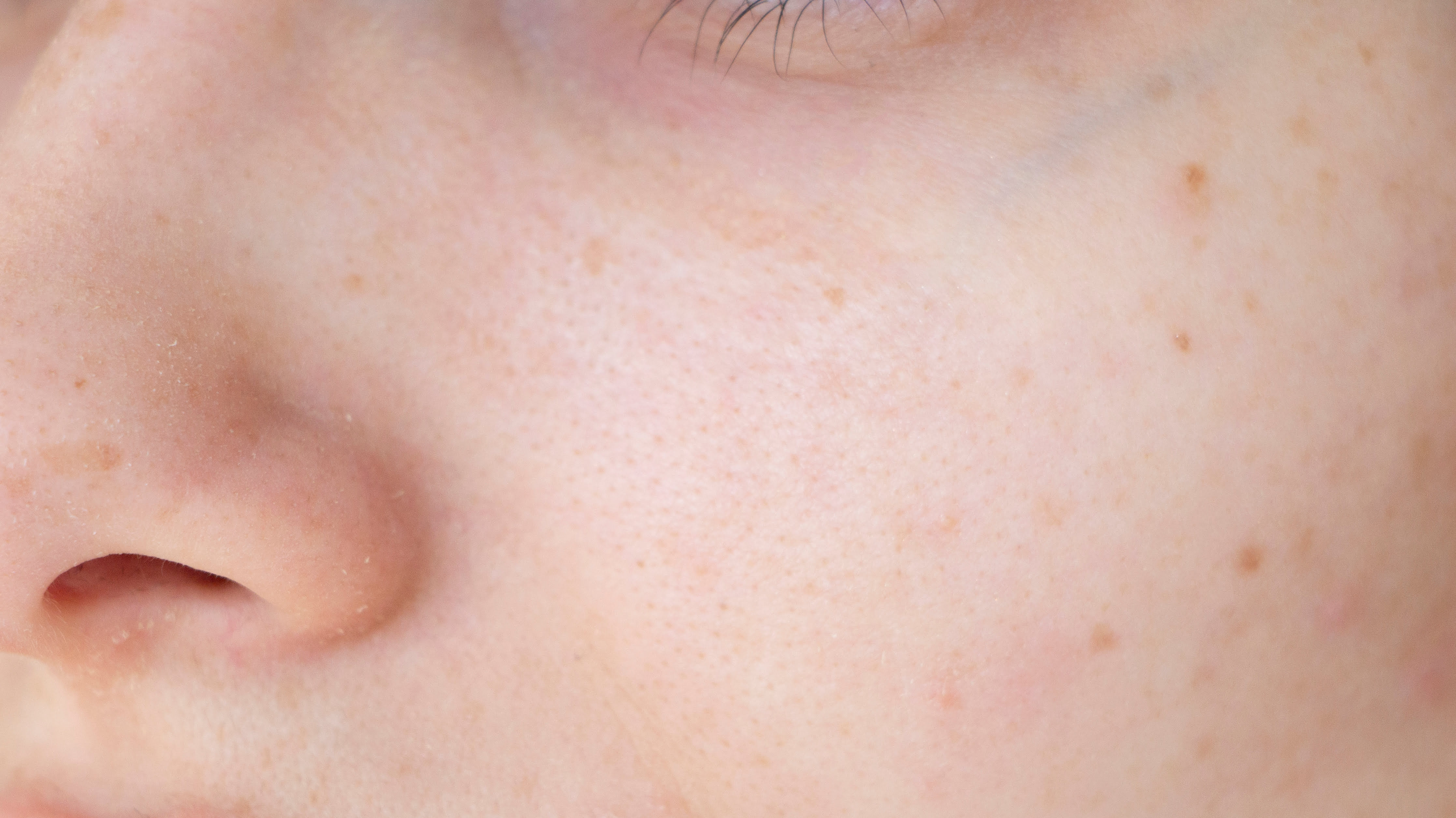 before laser pigmentation removal