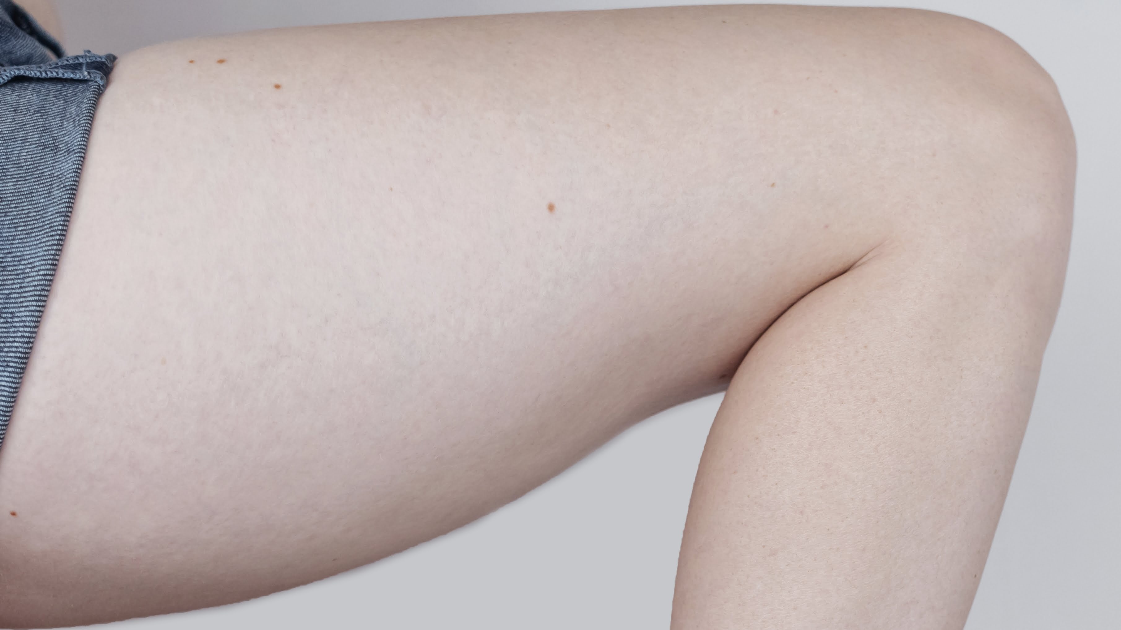 before lymphatic drainage legs