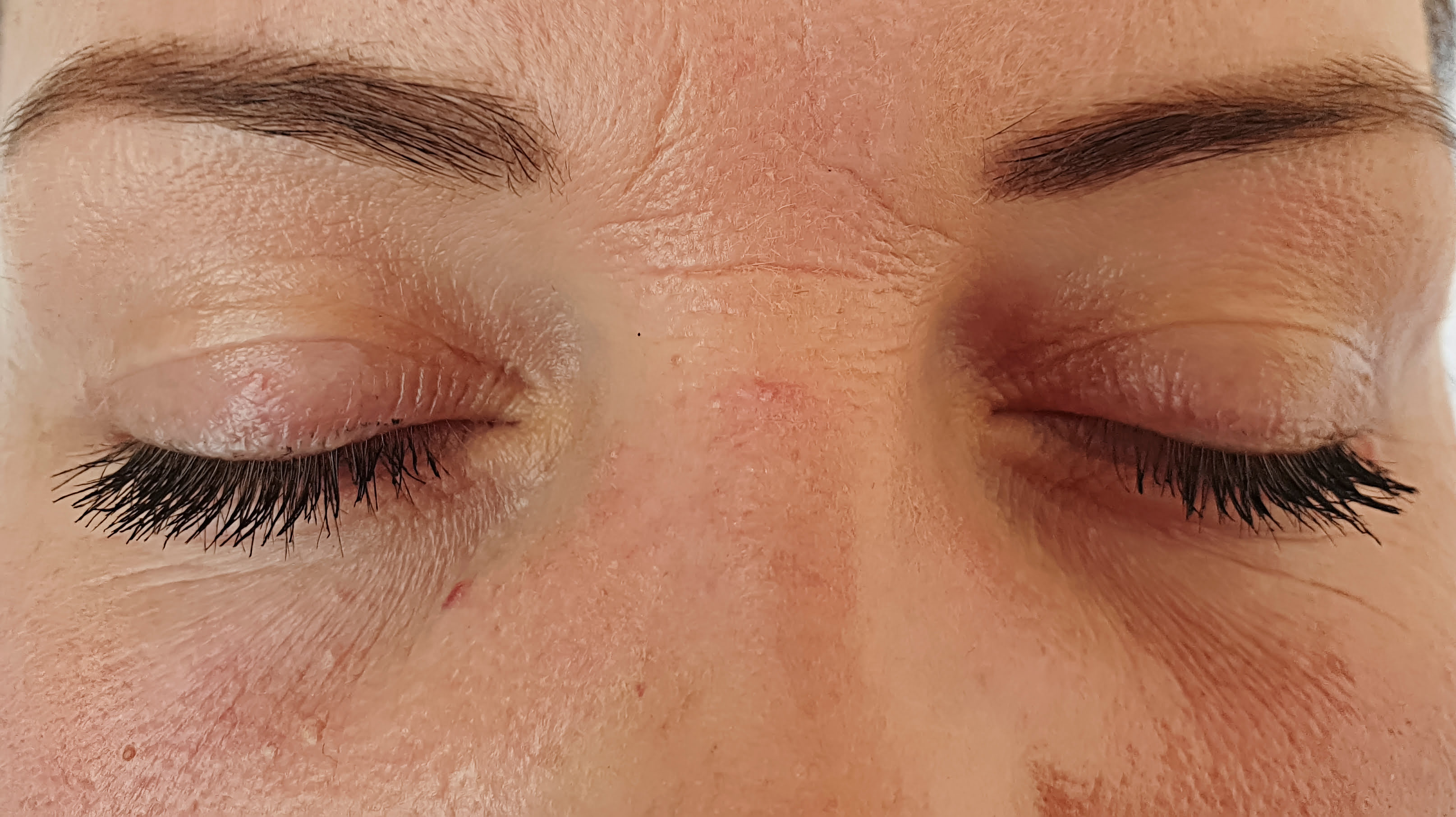 before profhilo treatment