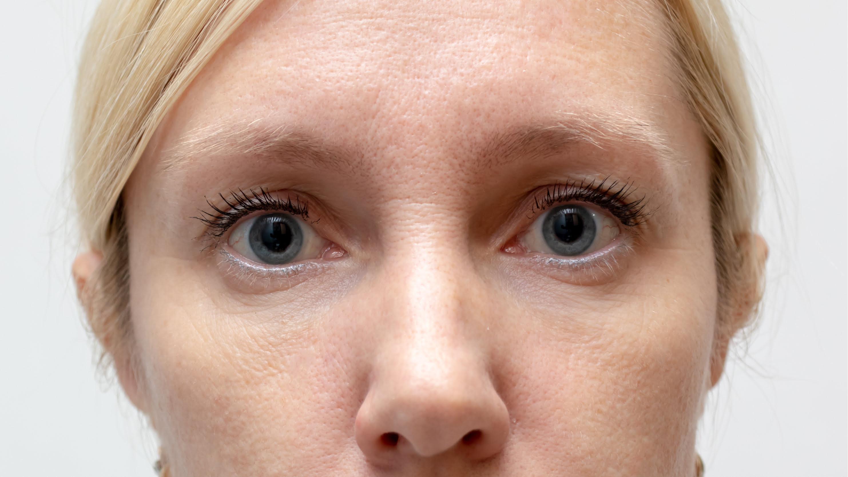 dermal fillers before