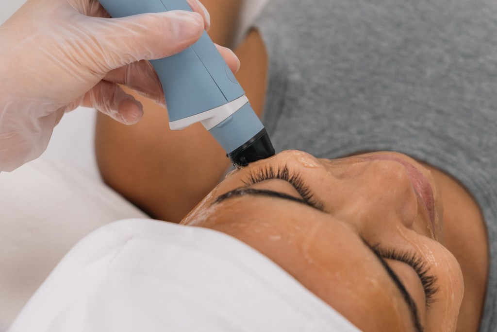 rf facial ultrasound treatment with device on face