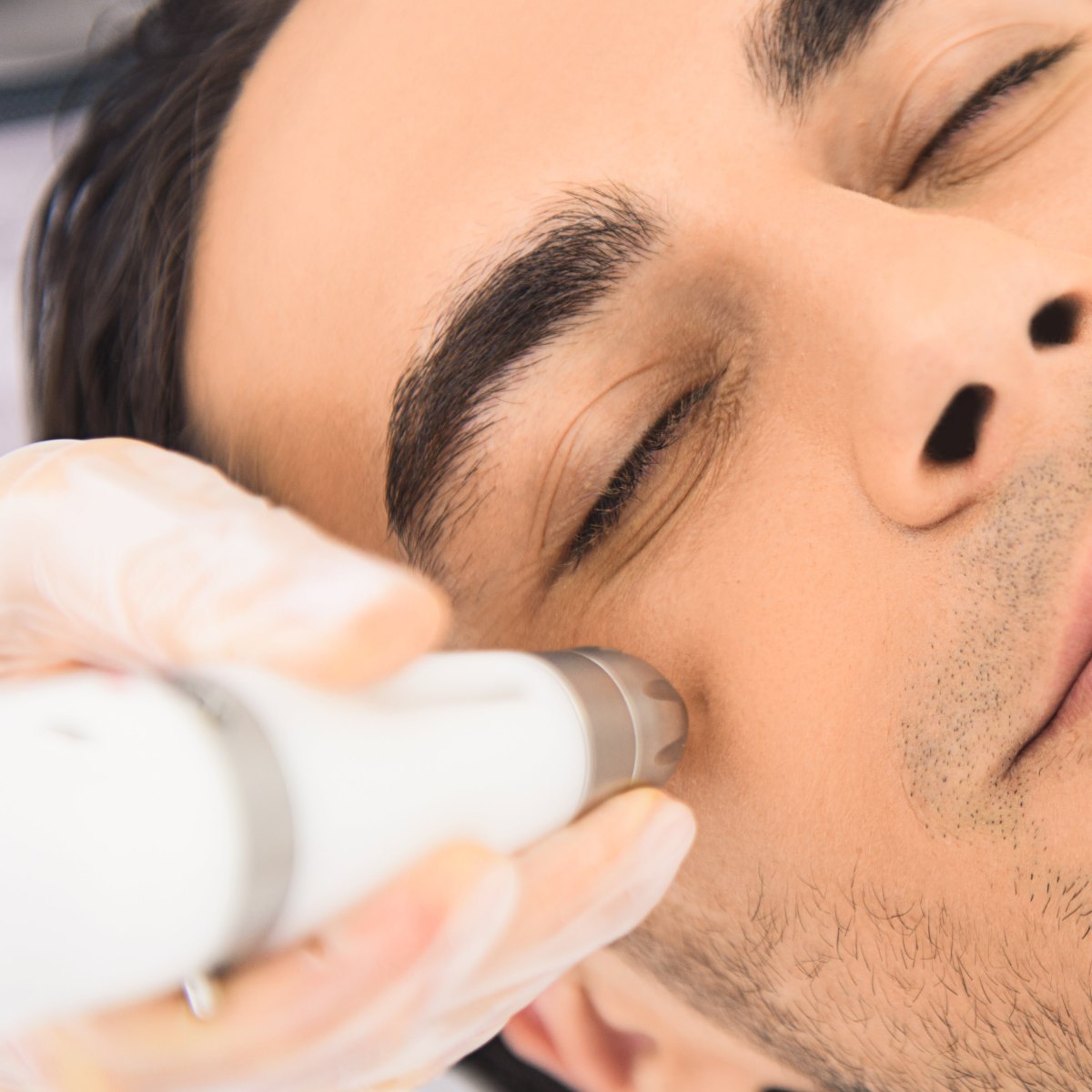 precisionlift procedure