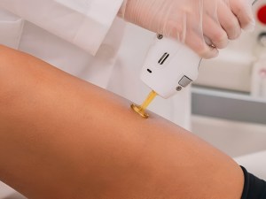 Laser Hair Removal for Men – La Rose Clinic