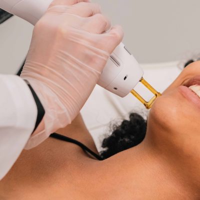 laser pigmentation removal for men