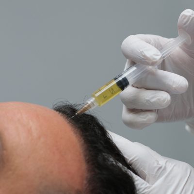 prp hair regrowth for men 2